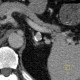 Aneurysm of lienal artery: CT - Computed tomography